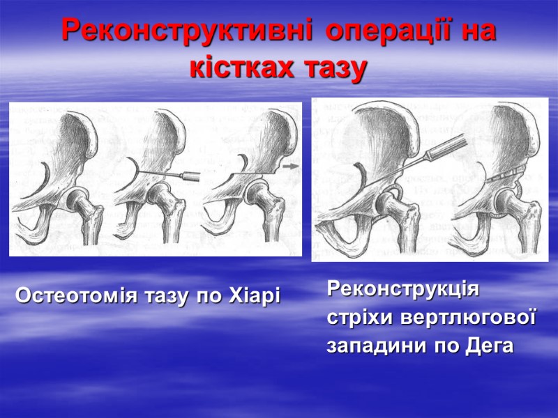 Реконструктивні операції на кістках тазу Остеотомія тазу по Хіарі Реконструкція  стріхи вертлюгової 